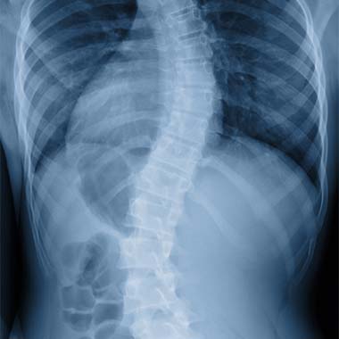 Can Chiropractic Help with Scoliosis?