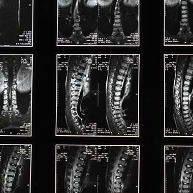 Can a Chiropractor Prevent Spinal Injuries?
