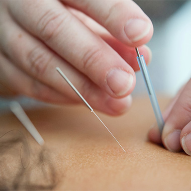 The Differences Between Acupuncture and Dry Needling