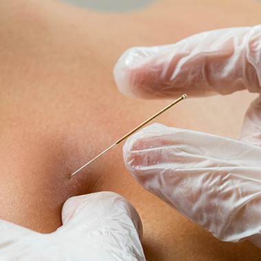 How Can Dry Needling Help with My Pain
