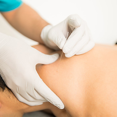 How Often Should You Get Dry Needling Treatments?