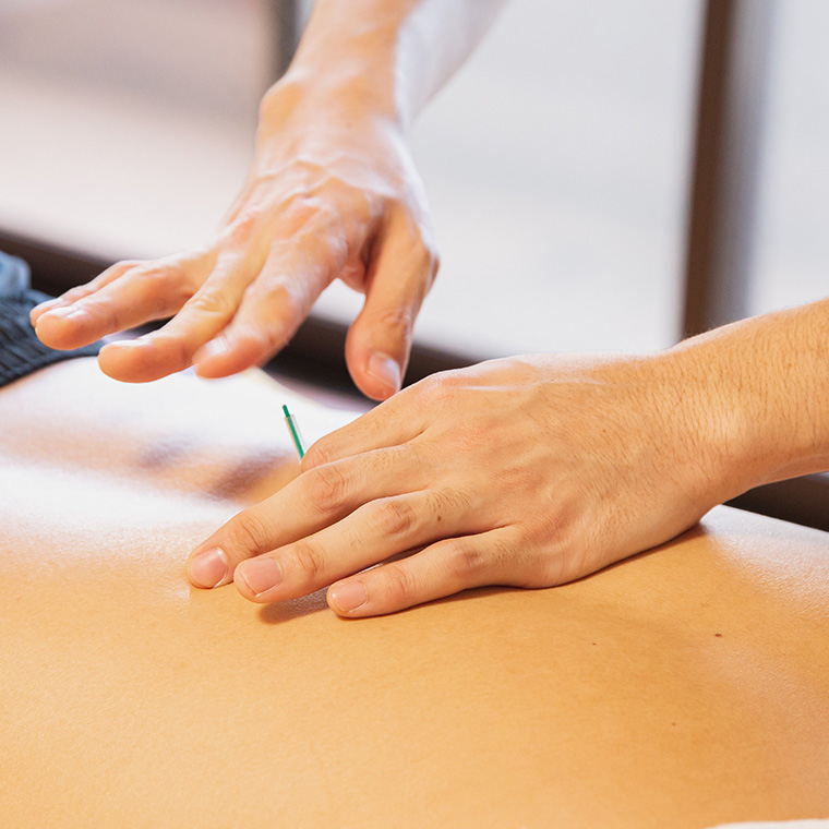 Dry Needling: Where is it Most Commonly Used and What Are the Benefits?