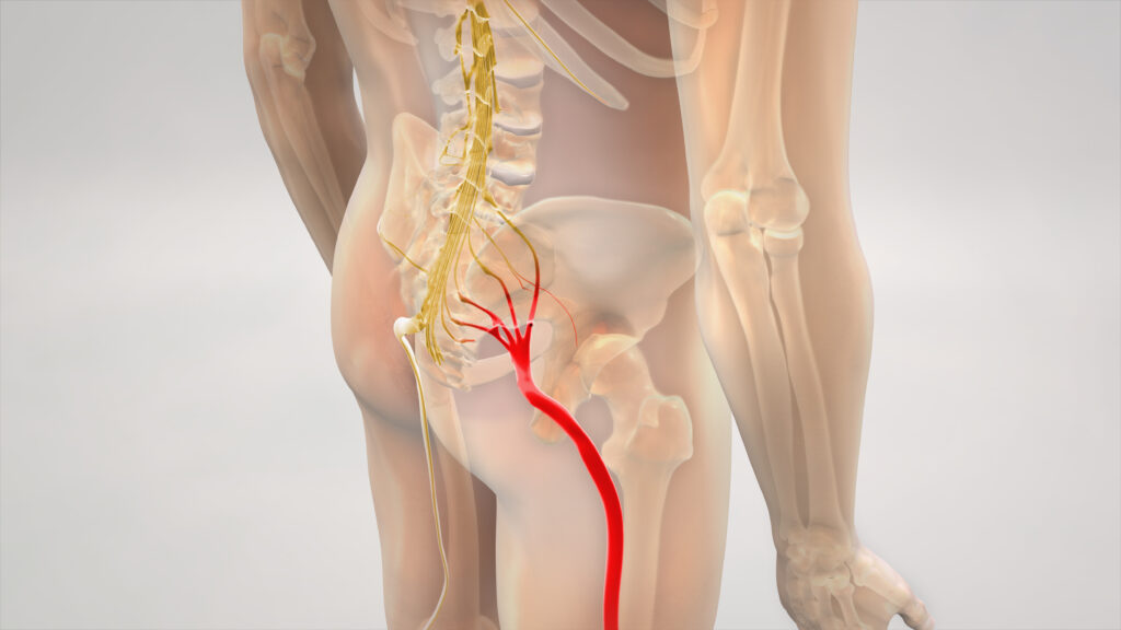 Sciatica - Chiropractic Centers of Erie & Longmont