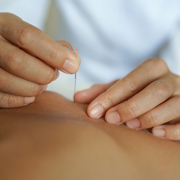 Dry Needling Preparation: A Step-by-Step Guide