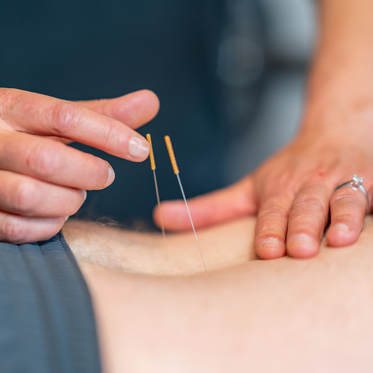 Where is Dry Needling Most Commonly Used?